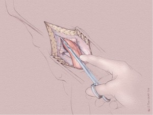 Groin Repair 2