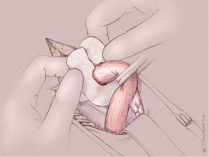 Groin Repair 01