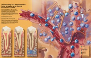 Tooth Abscess