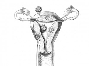 Uterine Fibroids